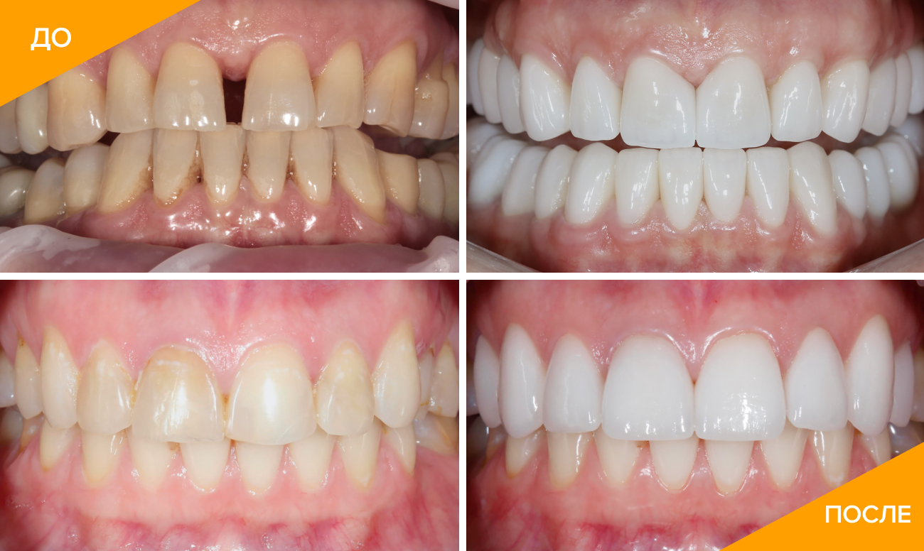 Фото зубов пациента до и после установки виниров в клинике SDent