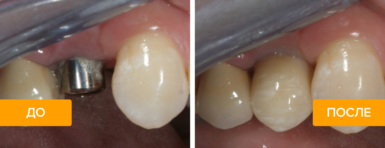 Фото до и после установки импланта с коронкой из диоксида циркония.