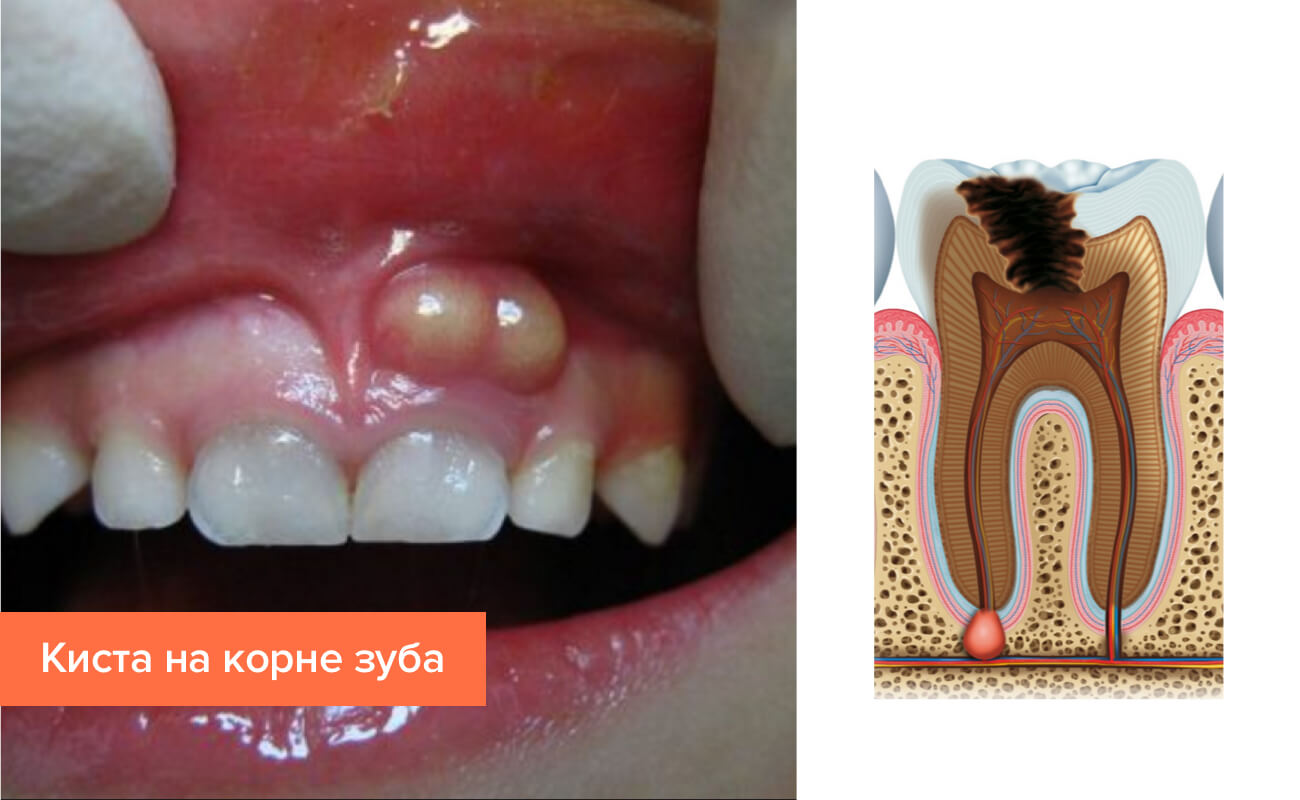 Фото кисты на корне зуба