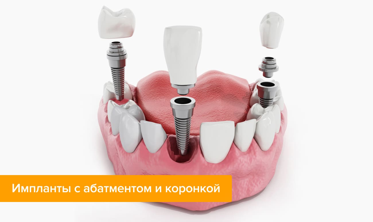 Импланты с абатментом и коронкой в картинках