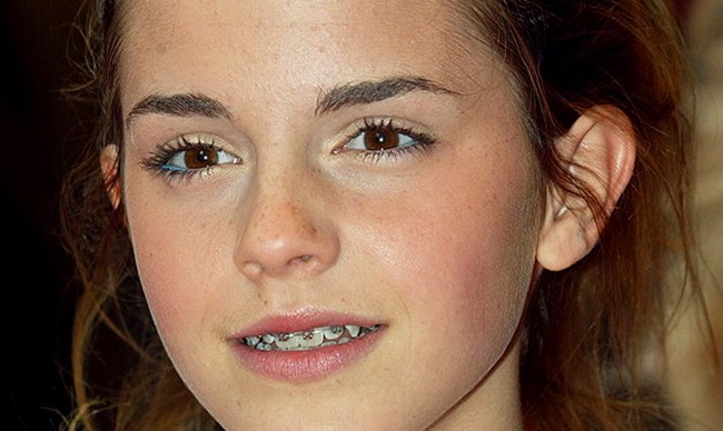 actresses with braces