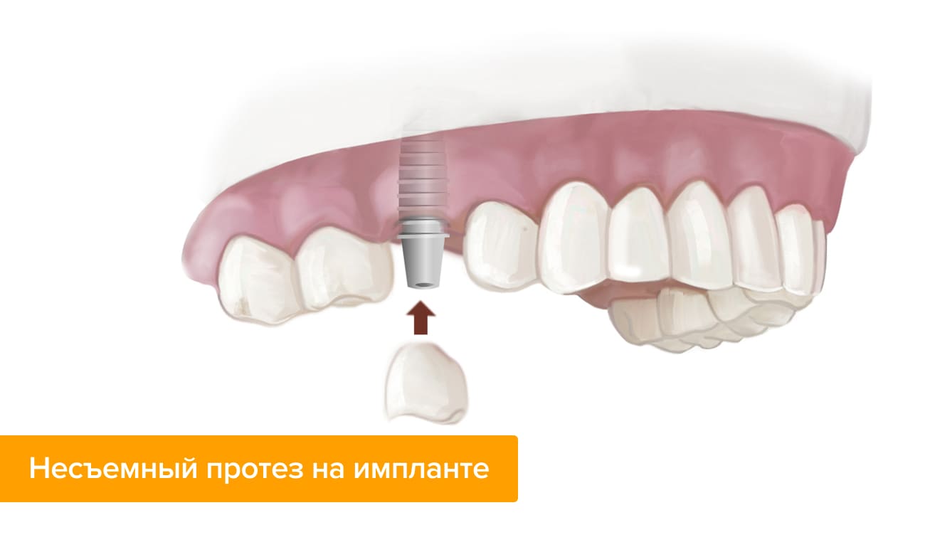 Несъемный протез на импланте Фото несъемного протеза на импланте