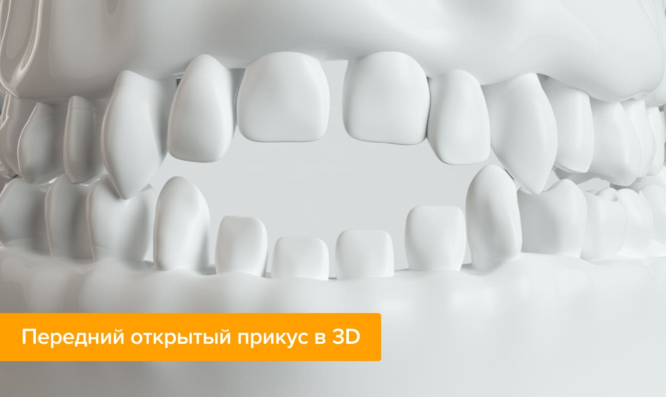 Передний открытый прикус в 3D