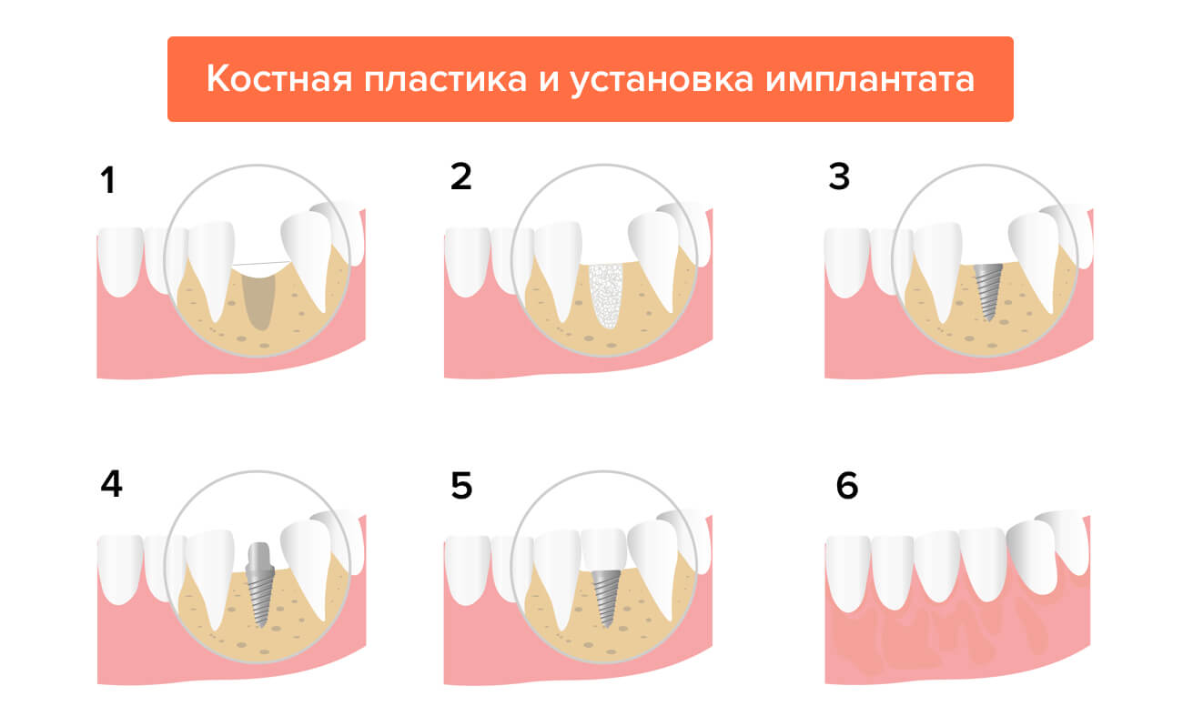 Костная ткань в стоматологии что это. Смотреть фото Костная ткань в стоматологии что это. Смотреть картинку Костная ткань в стоматологии что это. Картинка про Костная ткань в стоматологии что это. Фото Костная ткань в стоматологии что это