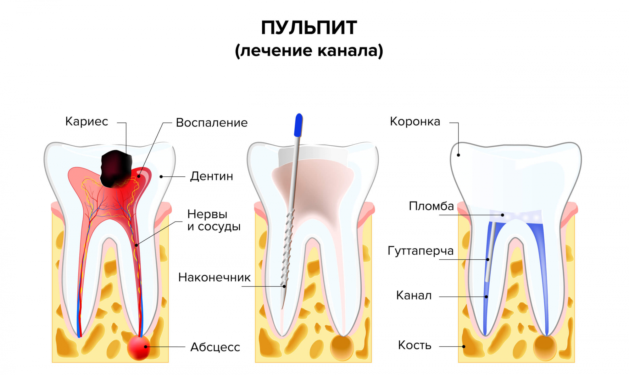 Процесс лечения пульпита в картинках