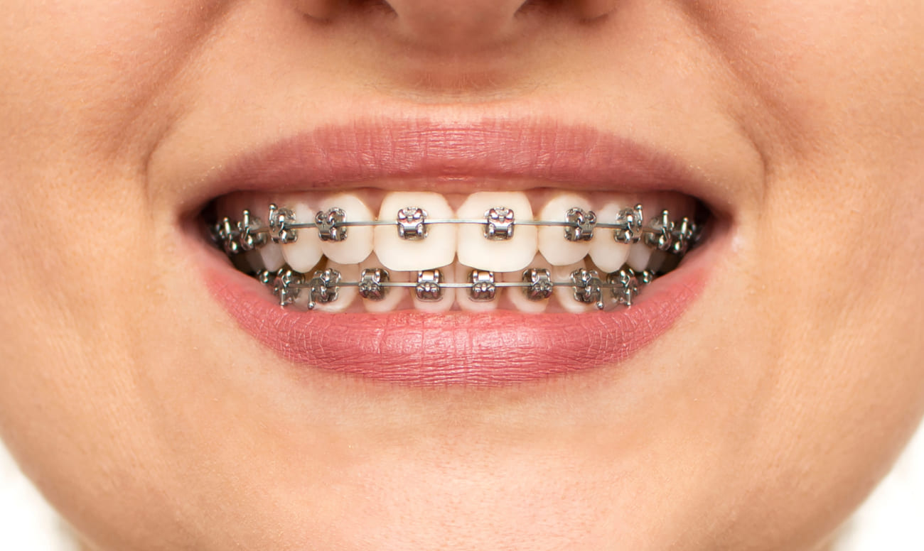 Фото металлических брекетов на зубах