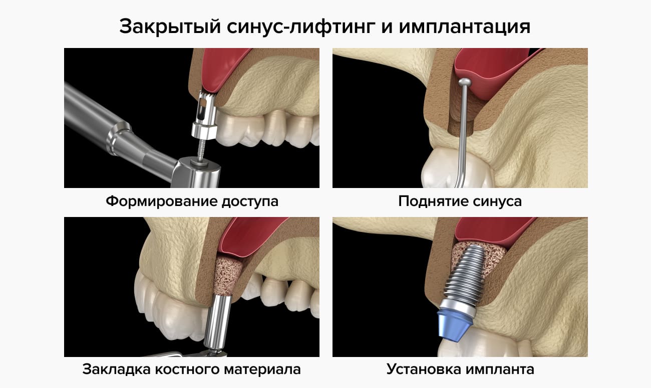 Презентация закрытый синус лифтинг