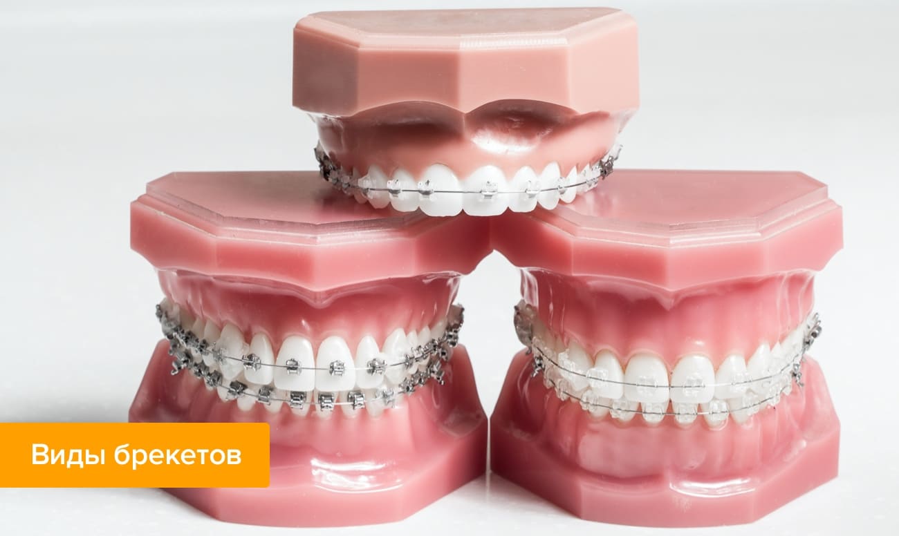 Фото различных видов брекетов на пластиковых моделях зубов