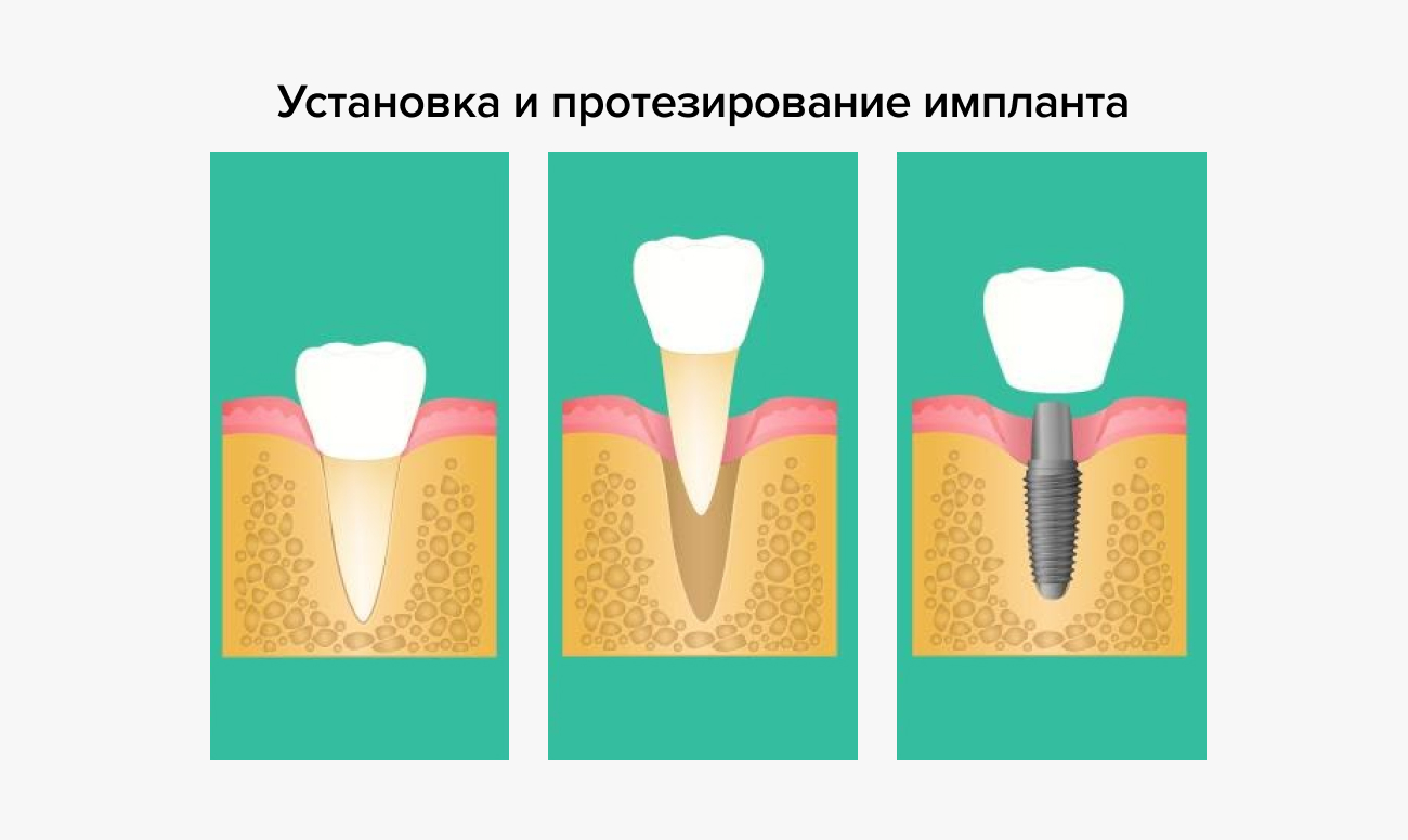 Установка коронки на имплант. Имплантация передних зубов особенности. Неправильно установлены коронки на абатмент. Имплант или мостовидный протез. Этапы имплантации передних зубов.