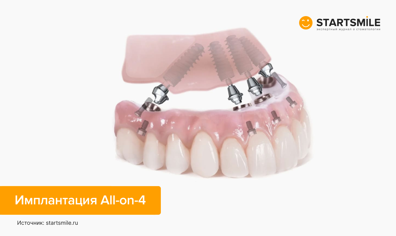 Имплантация All-on-4 в картинках