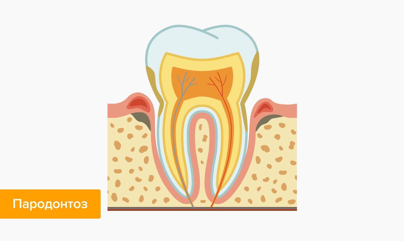 Пародонтоз в картинках