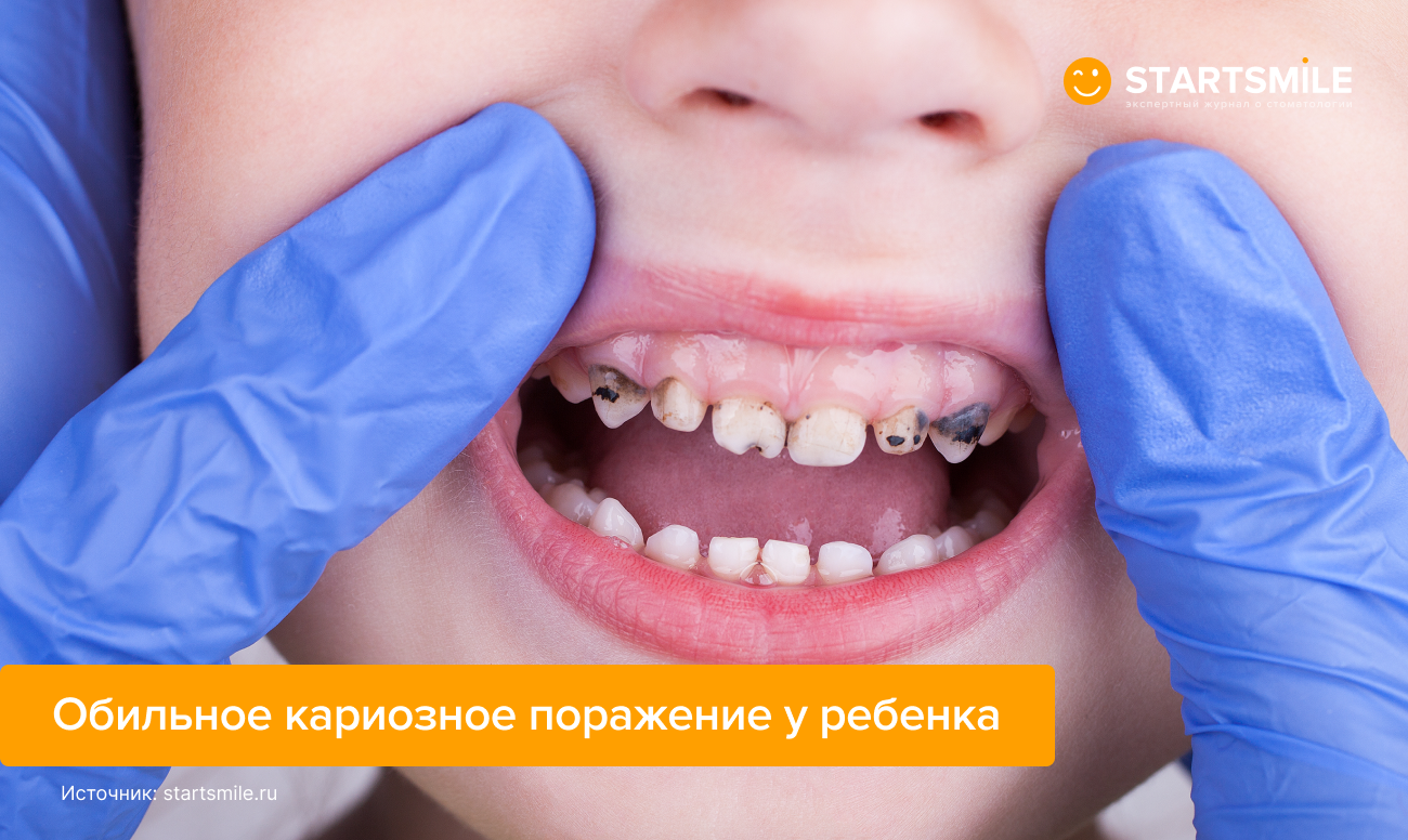 Фото зубов ребенка со множественным кариесом.