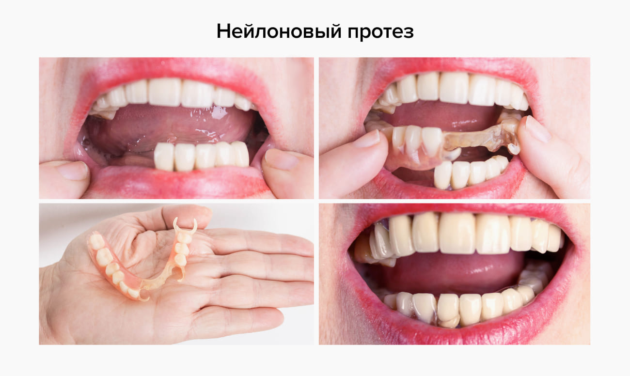 Фото нейлонового протеза на зубах