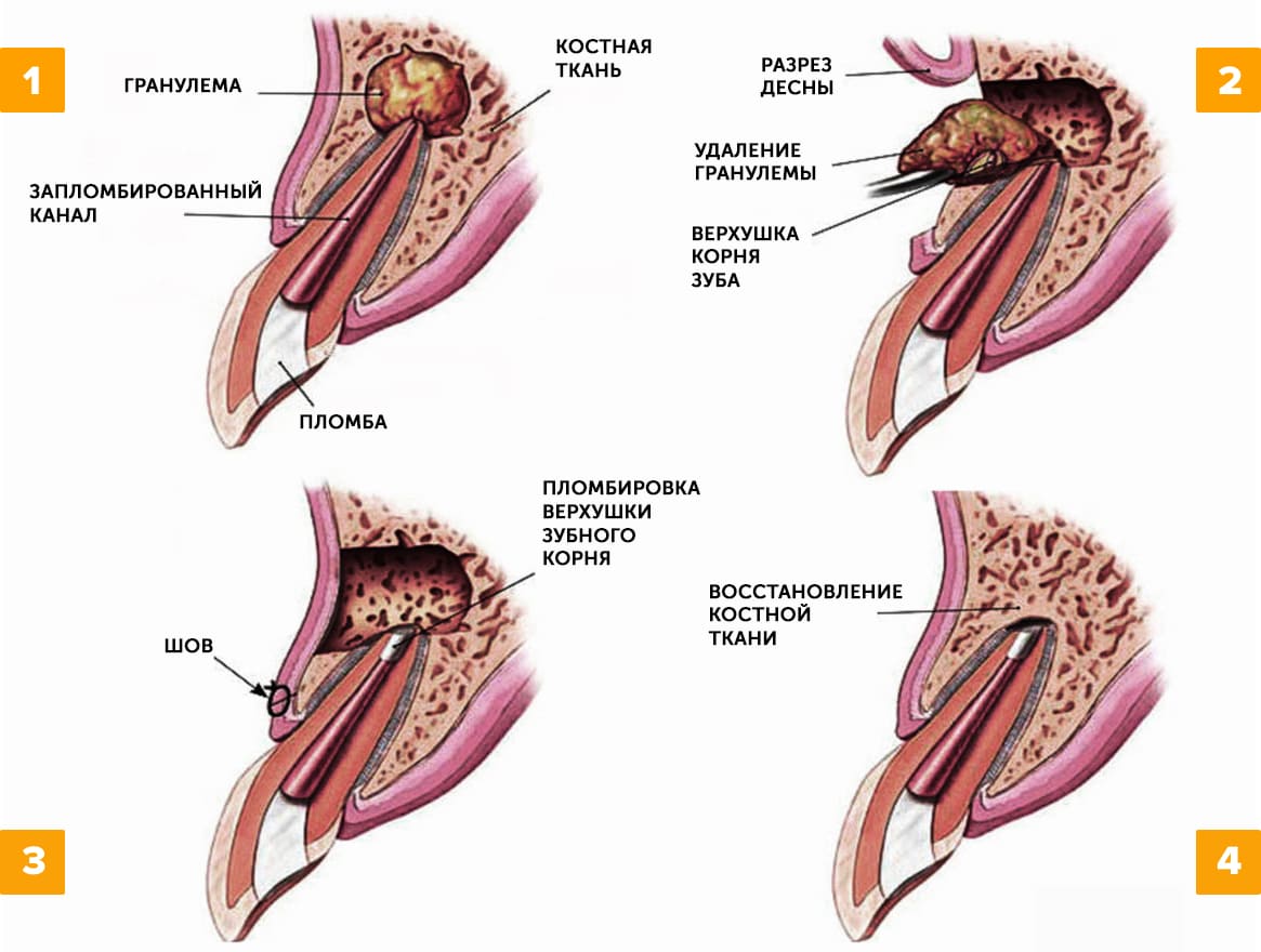 Удаление гранулемы зуба в картинках