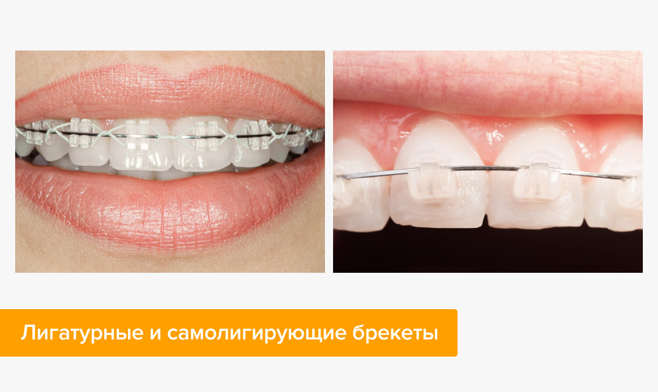 Фото лигатурных и самолигирующих брекетов