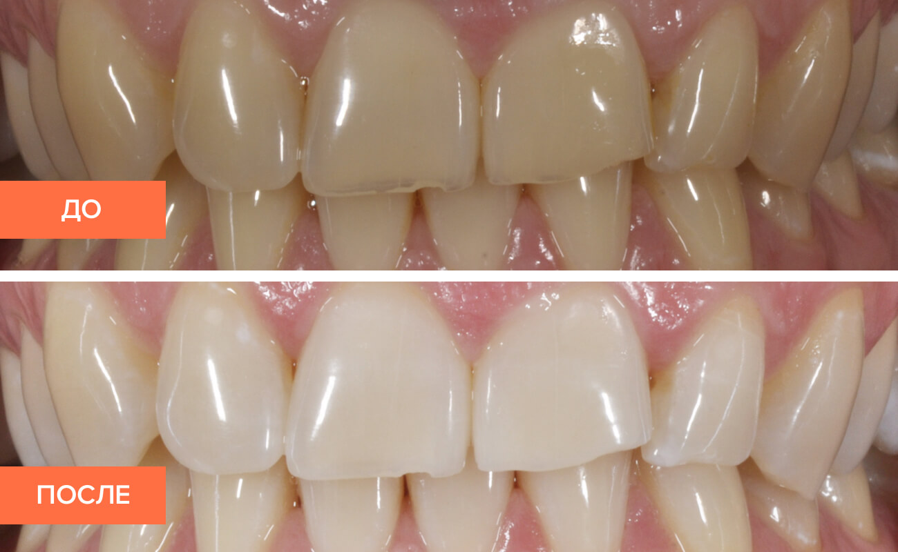 Фото зубов пациента до и после отбеливания по технологии Zoom