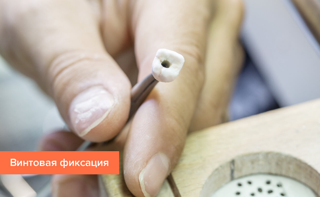 Фото металлокерамической коронки с винтовой фиксацией