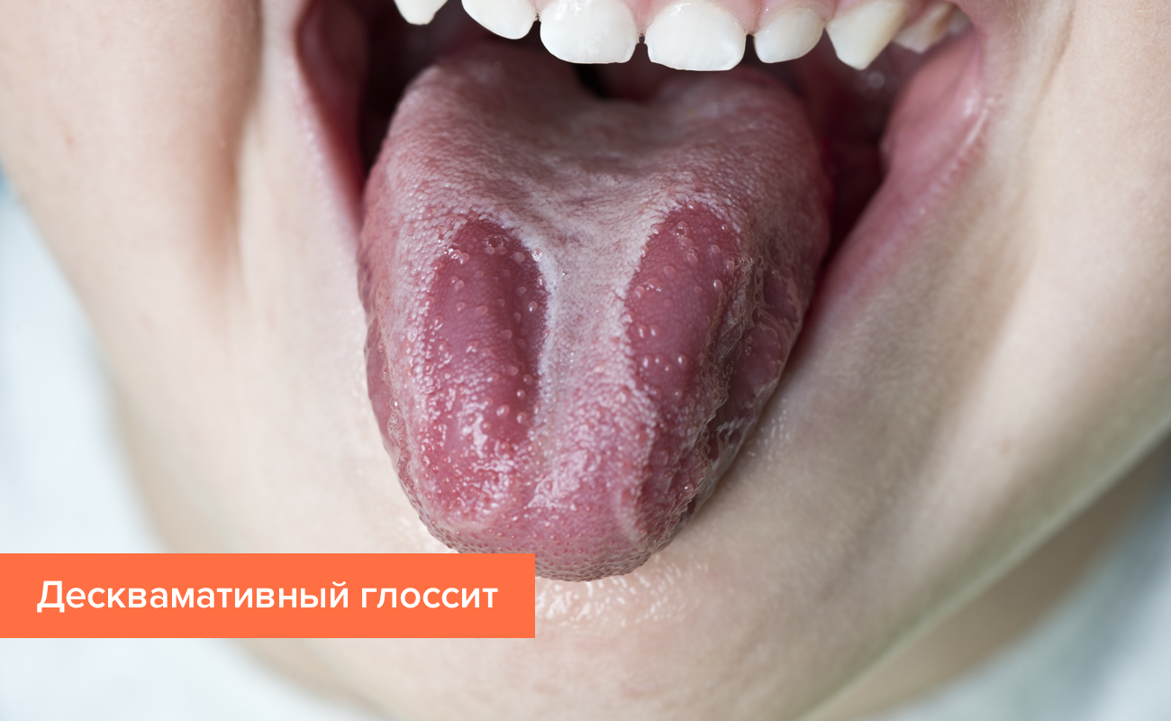 Обожгла Язык Фото Обожгла Язык Фото