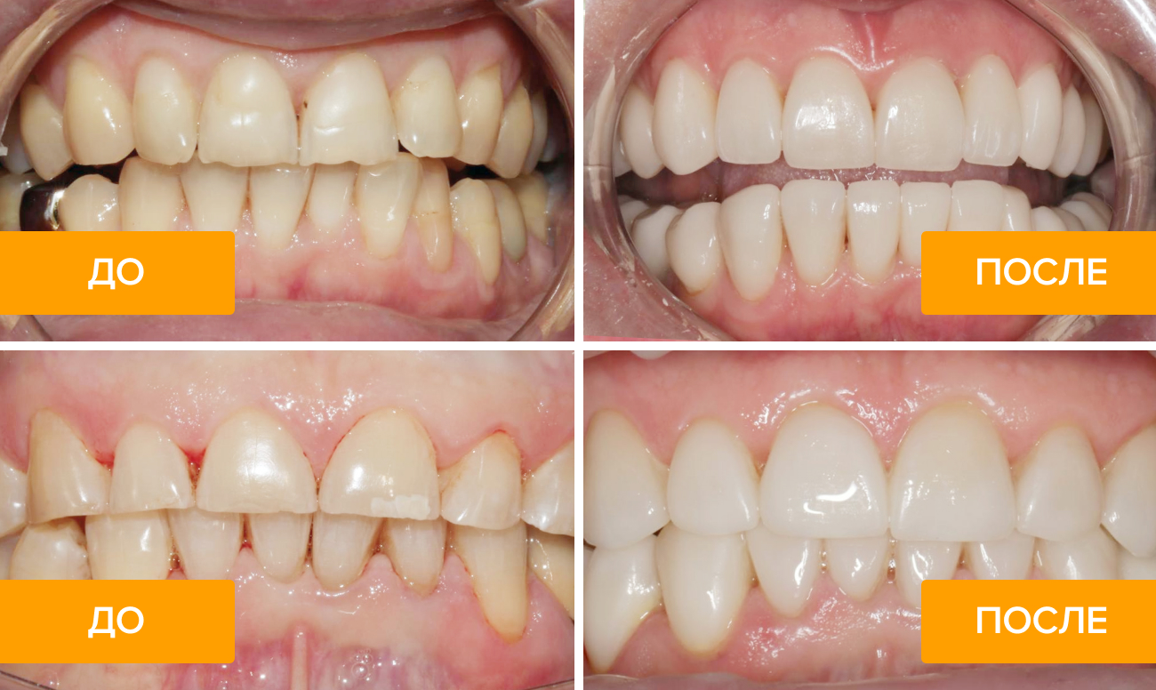 Фото зубов пациента до и после установки виниров в клинике Dent Revolution