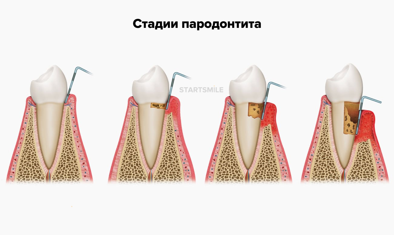 Стадии пародонтита в картинках.