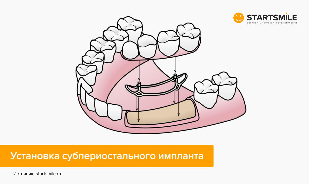 Установка субпериостального импланта в картинках.