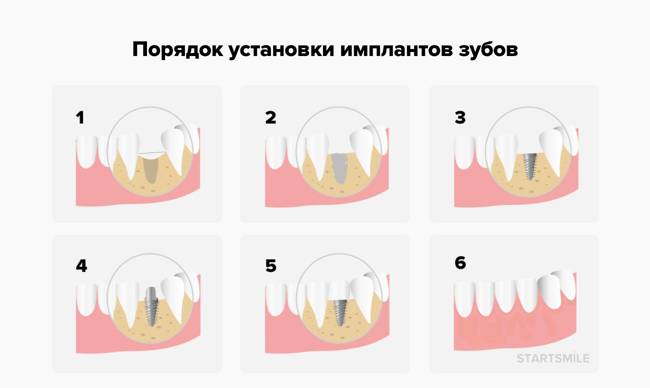 Порядок установки имплантов зубов в картинках