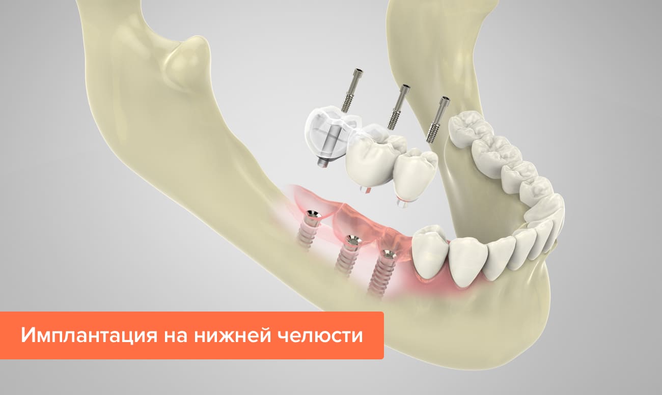 Фото имплантации на нижней челюсти