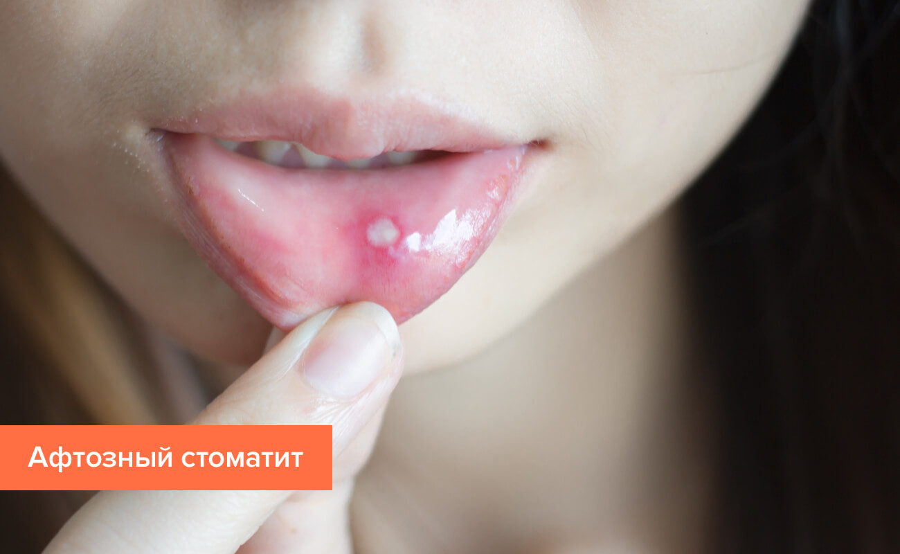 Афтозный стоматит Фото афтозного стоматита