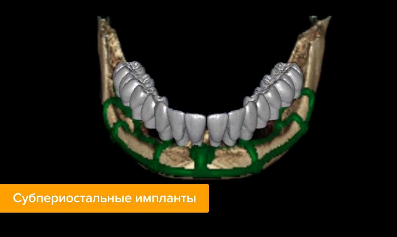 Субпериостальные импланты Фото субпериостальных имплантов