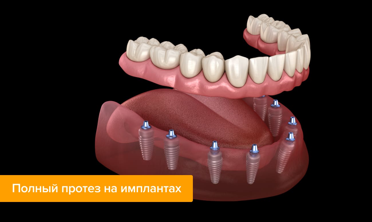 Полный протез на имплантах в картинках