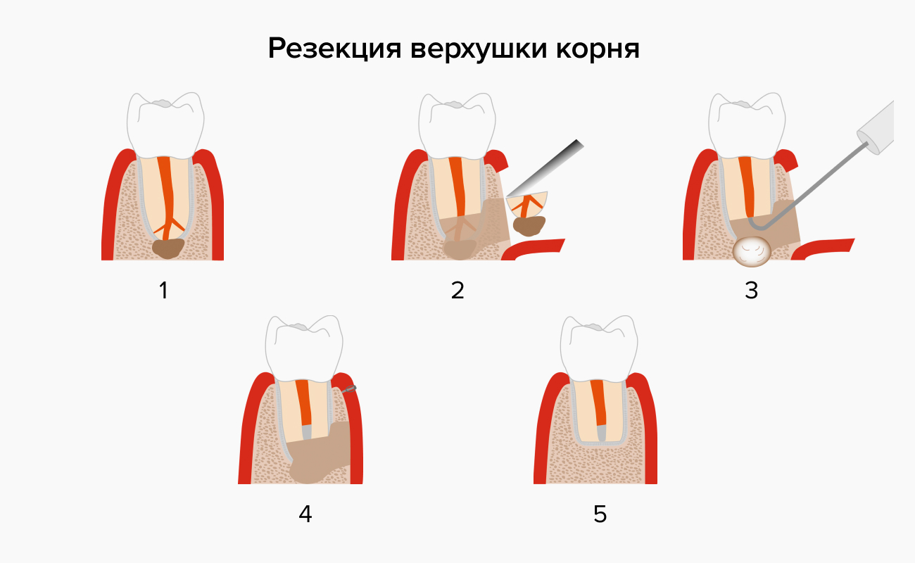 Резекция верхушки корня в картинках