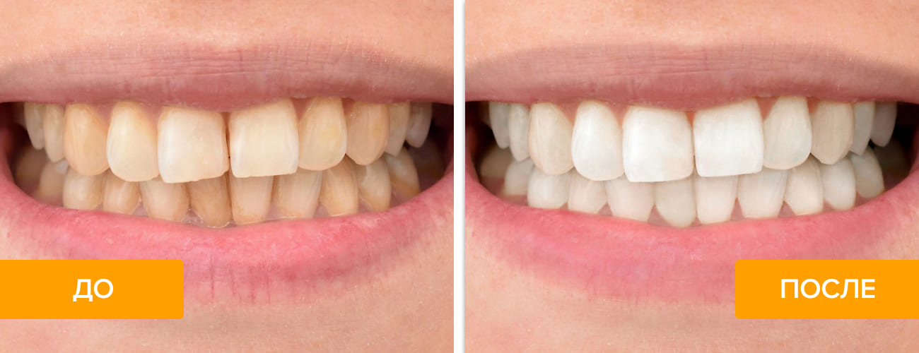 Фото зубов до и после удаления налета