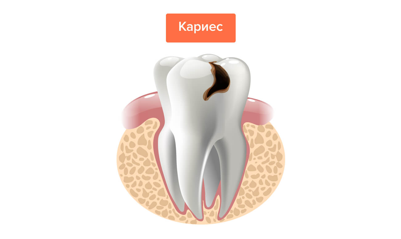 Кариес в картинках