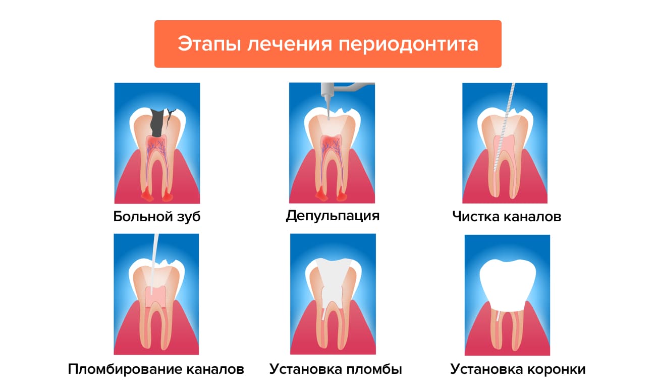 Этапы лечения периодонтита в картинках