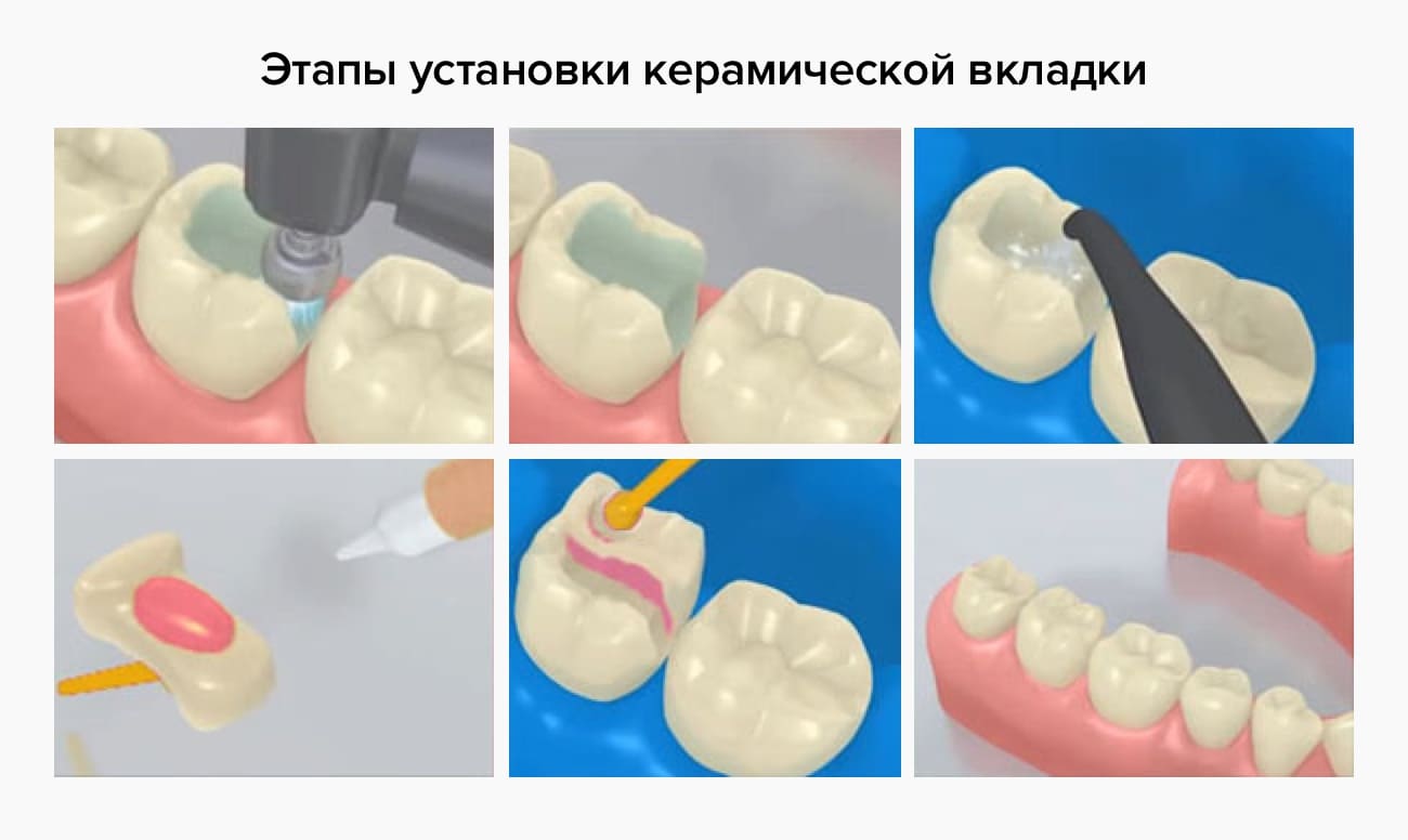 Этапы установки керамических вкладок в картинках