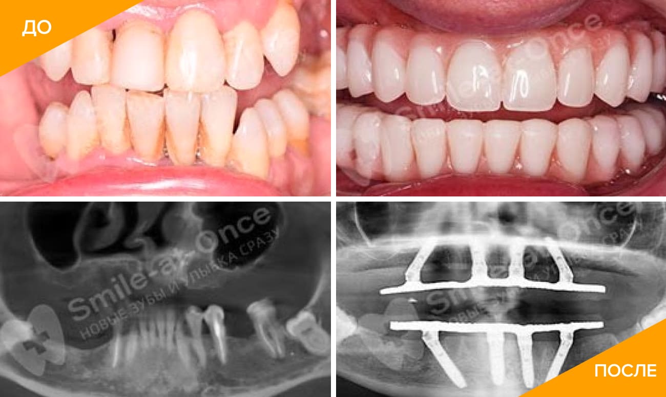Фото пациента до и после установки съемного протеза на импланты