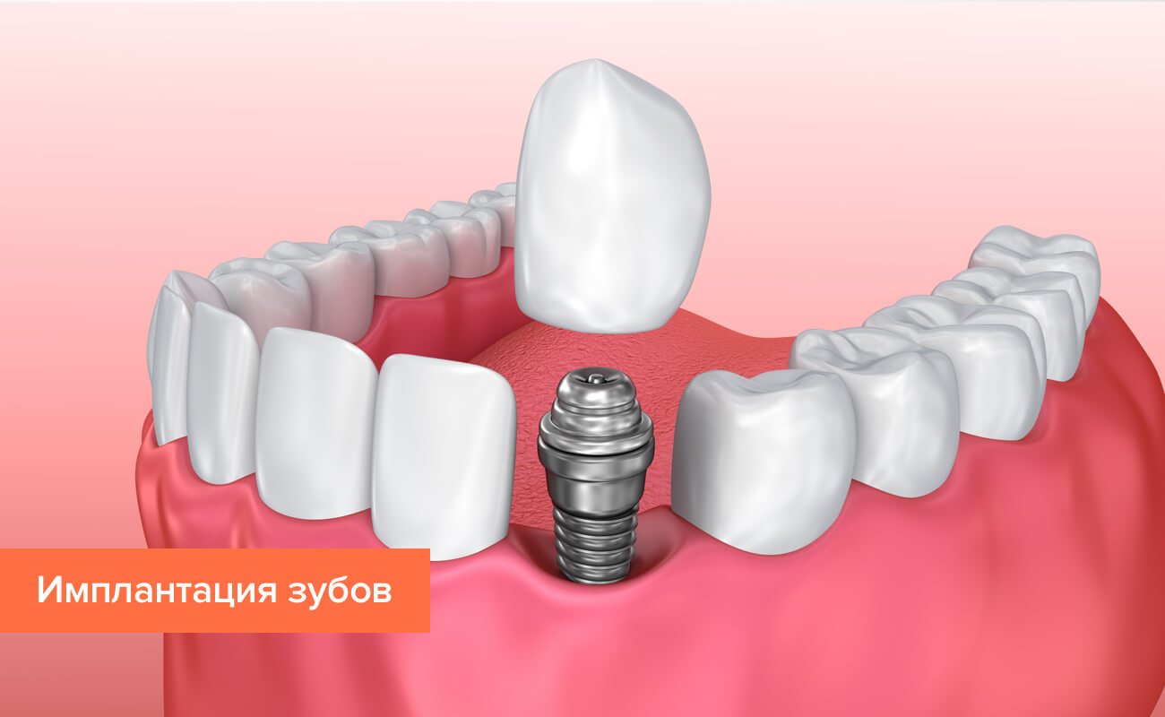 Графика имплантации зубов