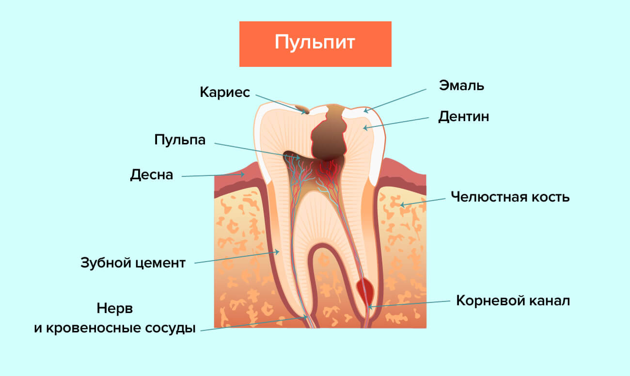 Пульпит в картинках