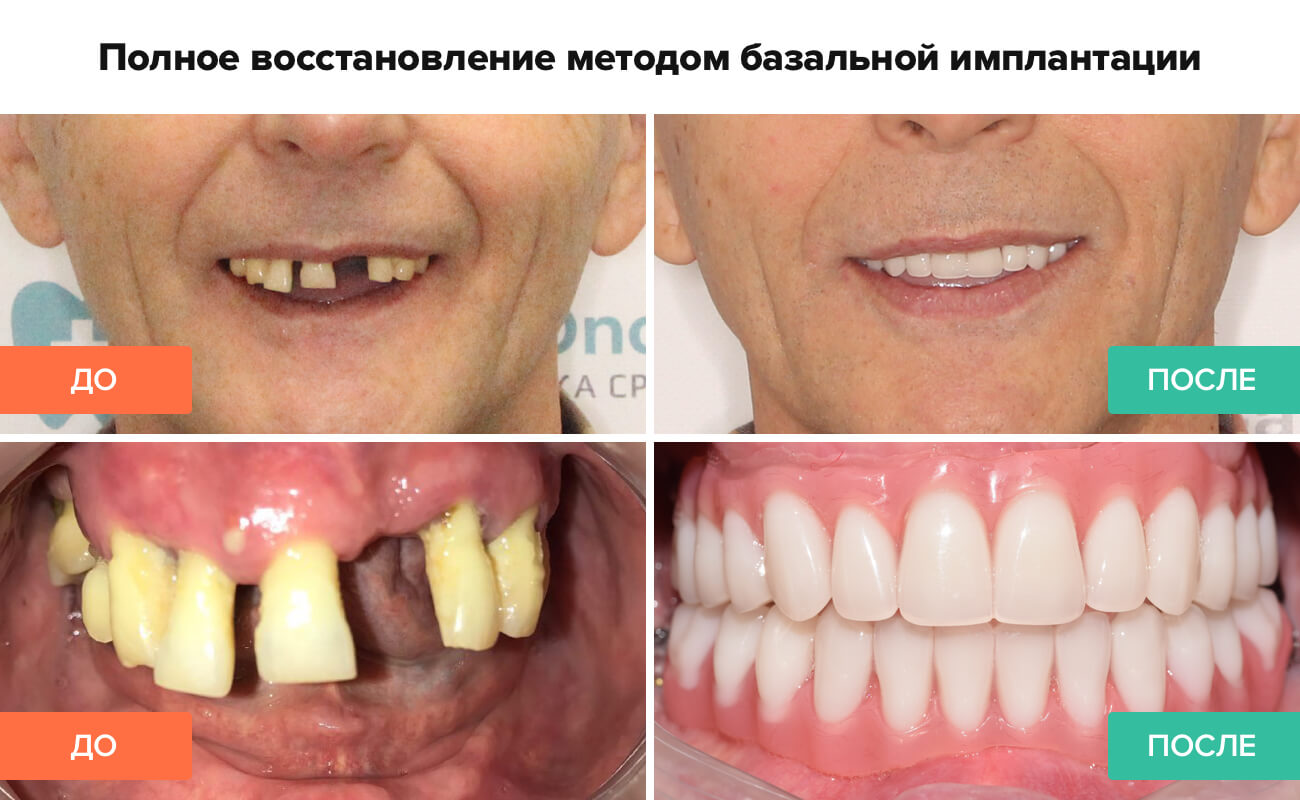 Фото до и после базальной имплантации Фото пациента до и после базальной имплантации