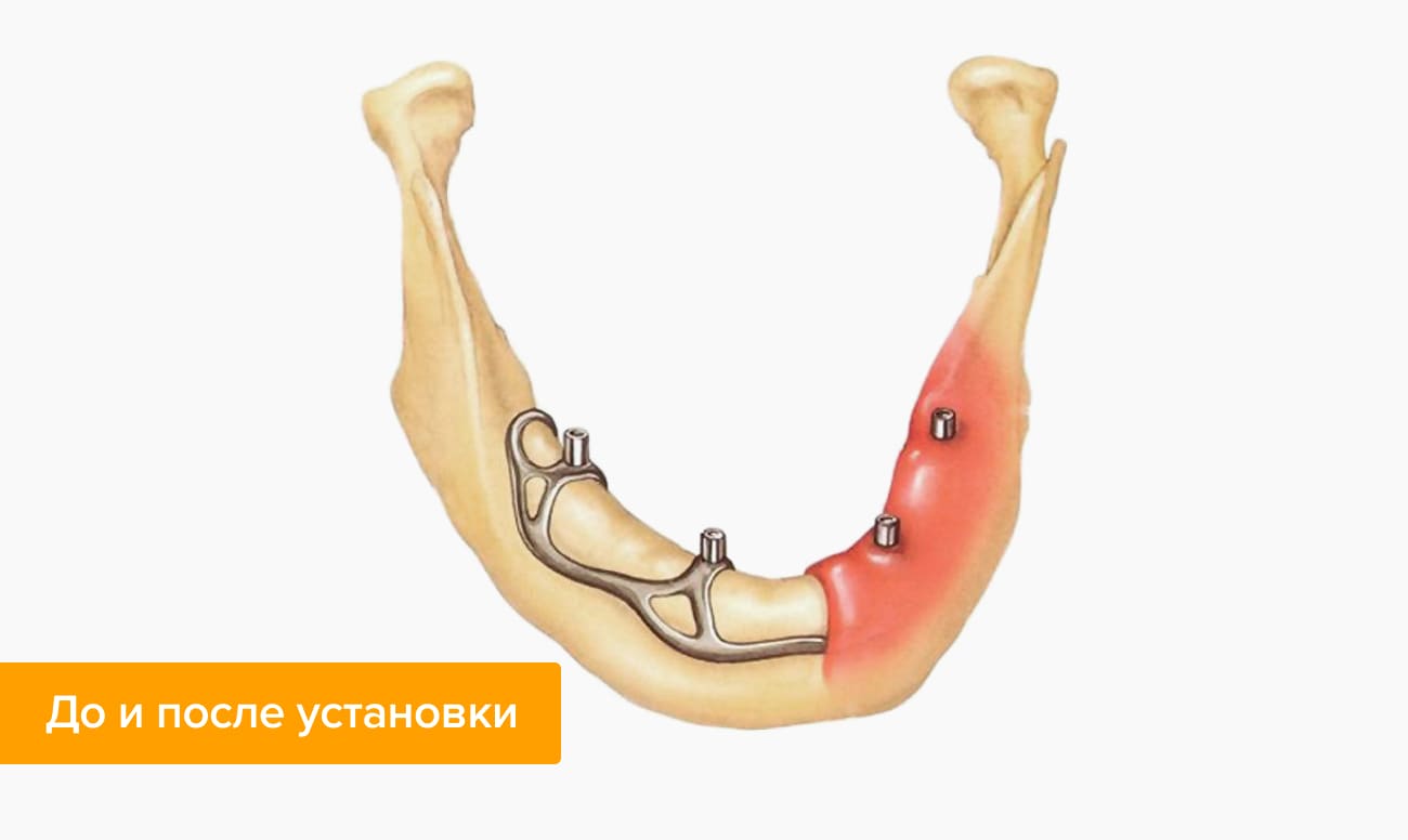 субпериостальная имплантация что это. Смотреть фото субпериостальная имплантация что это. Смотреть картинку субпериостальная имплантация что это. Картинка про субпериостальная имплантация что это. Фото субпериостальная имплантация что это