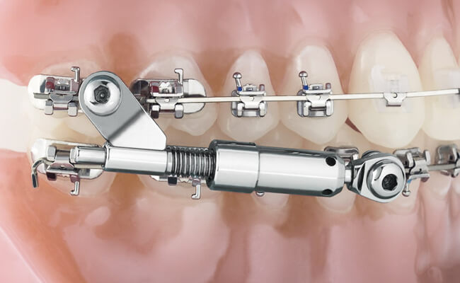 Брекеты Mini-Mono Forestadent Фото брекетов Mini-Mono Forestadent