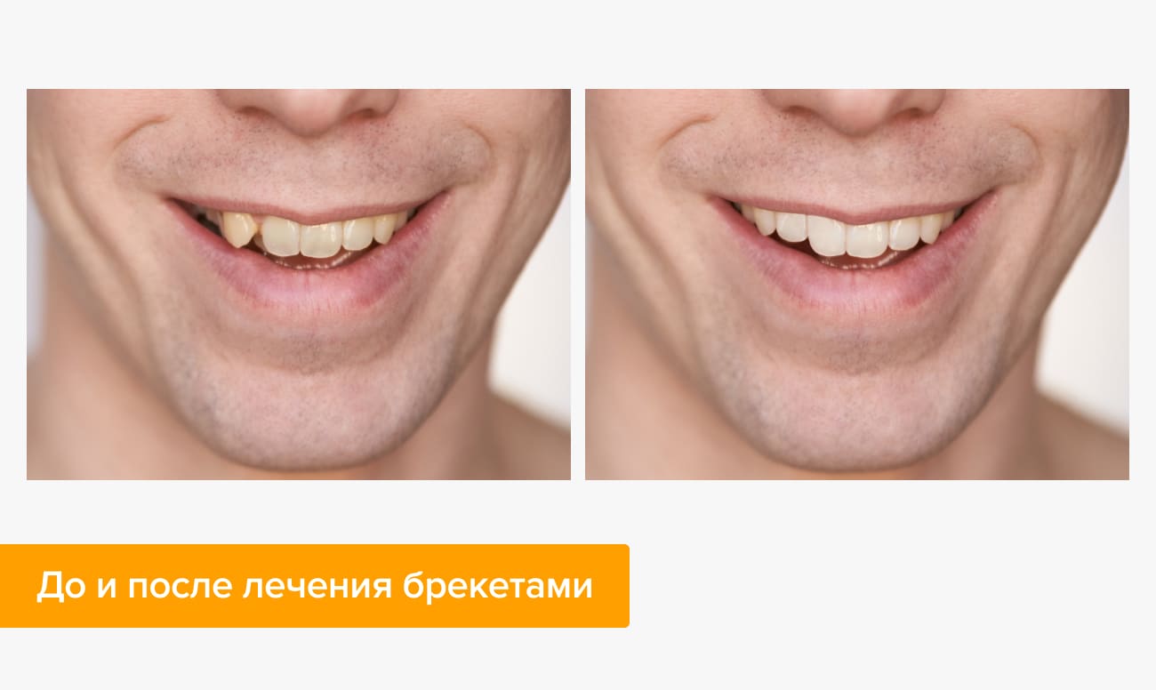 Что выбрать брекеты или виниры. Смотреть фото Что выбрать брекеты или виниры. Смотреть картинку Что выбрать брекеты или виниры. Картинка про Что выбрать брекеты или виниры. Фото Что выбрать брекеты или виниры