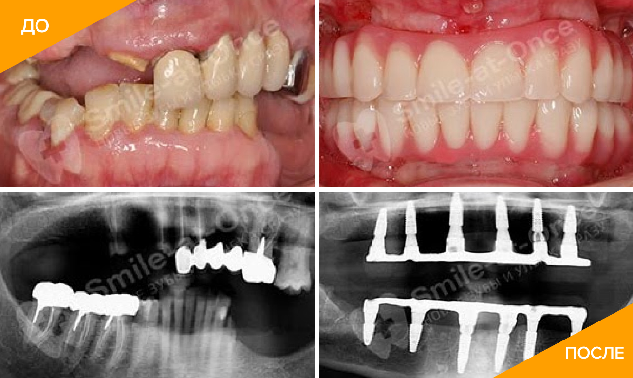 Фото пациента до и после полного протезирования зубов