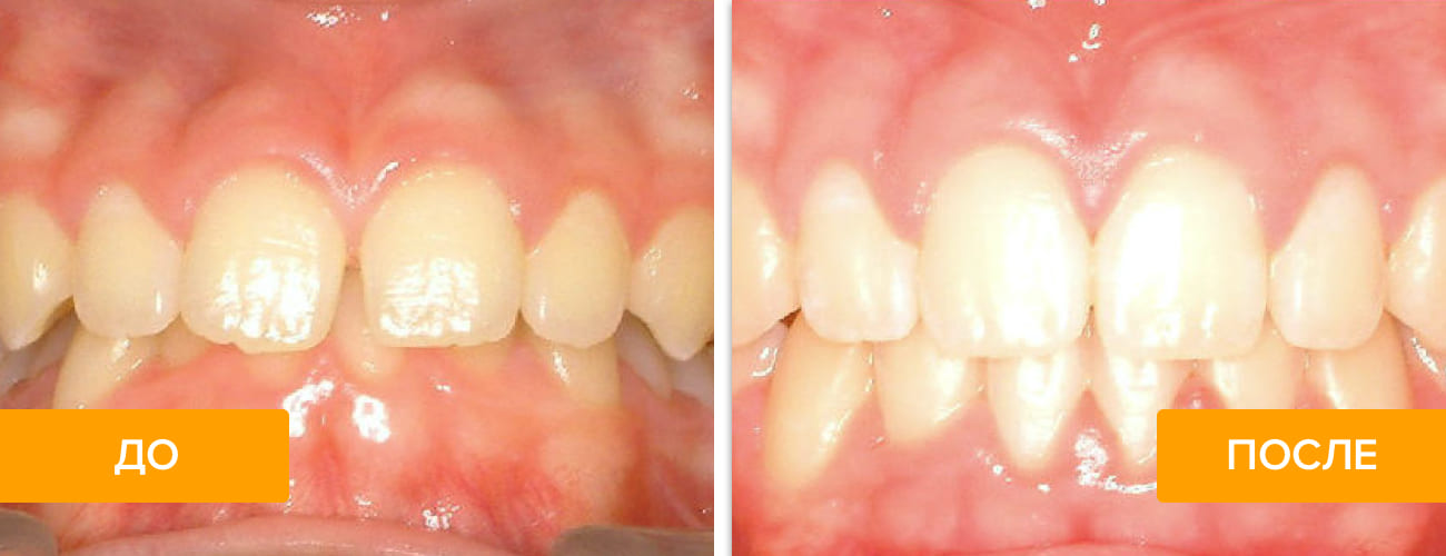 Фото до и после исправления глубокого прикуса