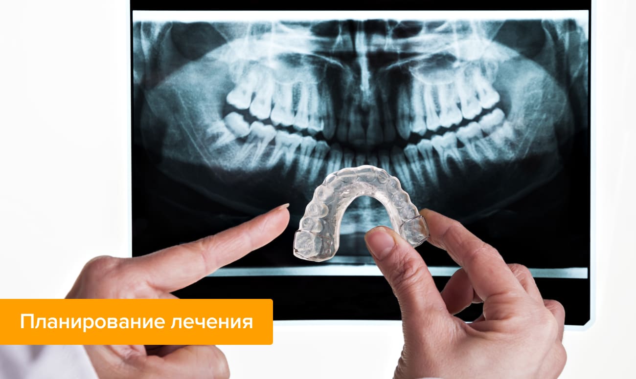 Фото снимка зубов перед лечением капами Invisalign