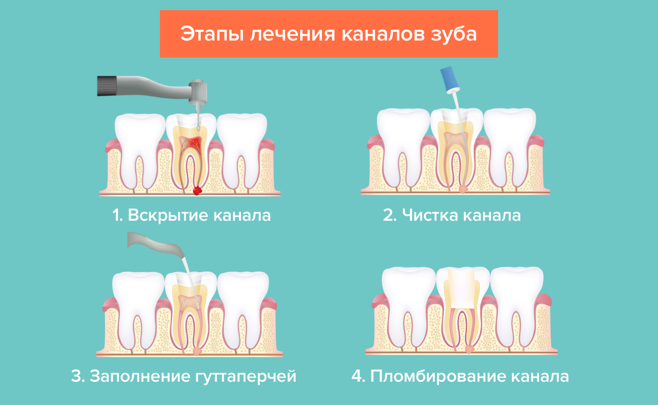 Этапы лечения каналов зуба в картинках