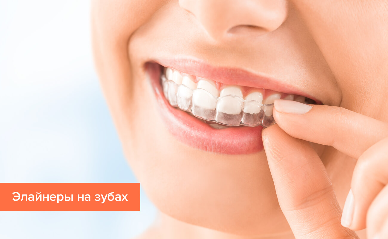Элайнеры Invisalign на зубах Элайнеры Invisalign на зубах