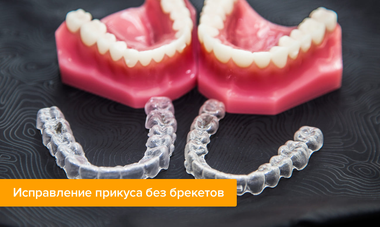 Фото кап для исправление прикуса без брекетов
