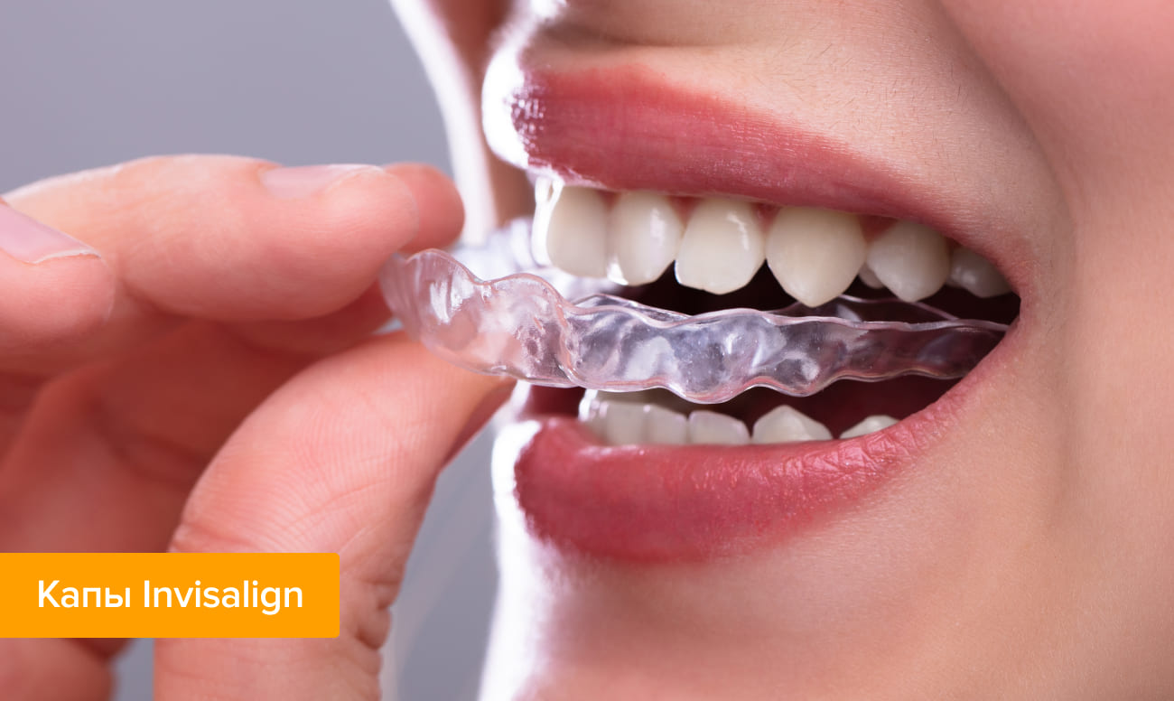 Фото кап Invisalign