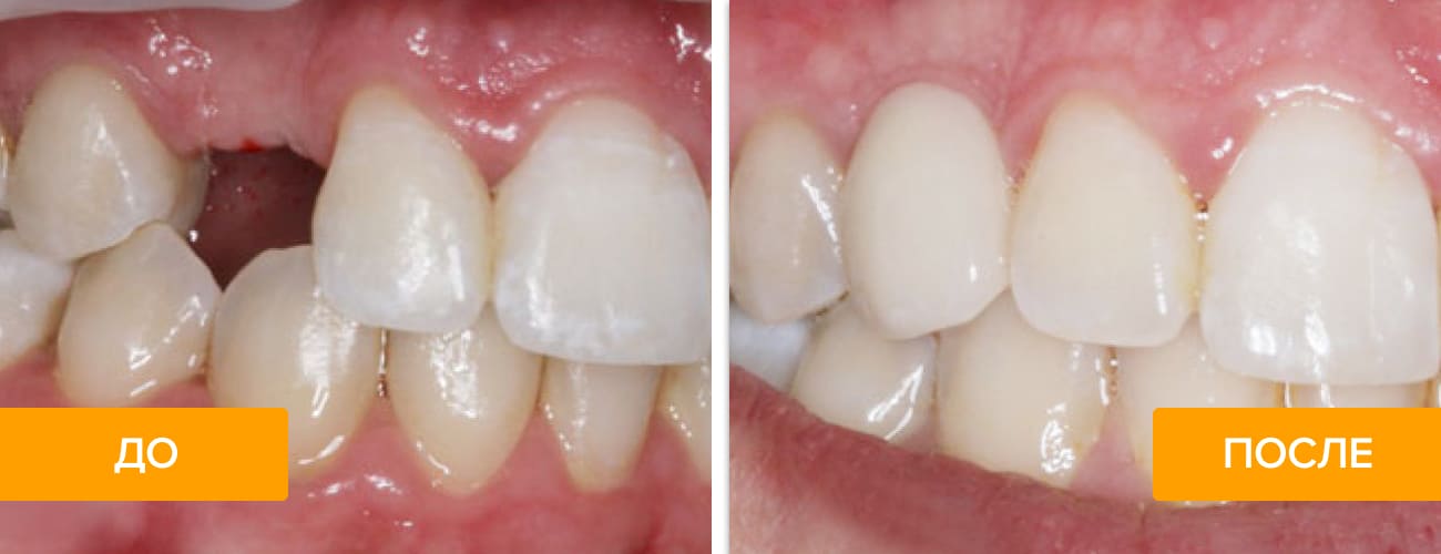Фото до и после установки импланта зуба